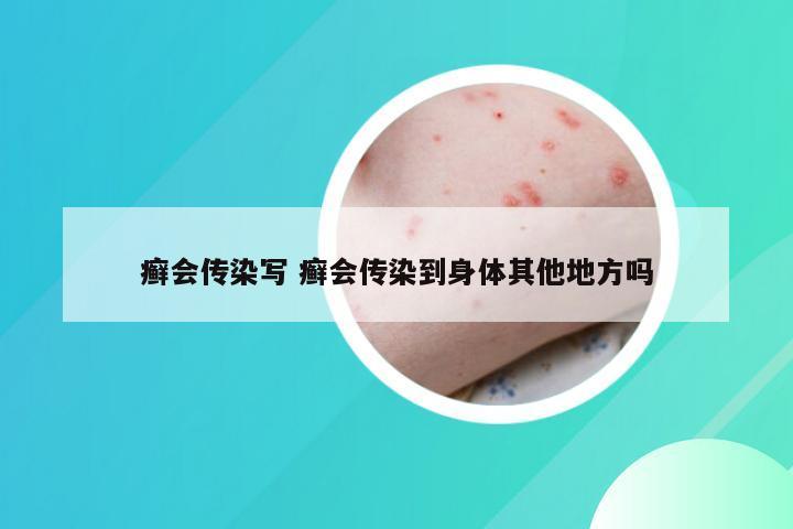 癣会传染写 癣会传染到身体其他地方吗