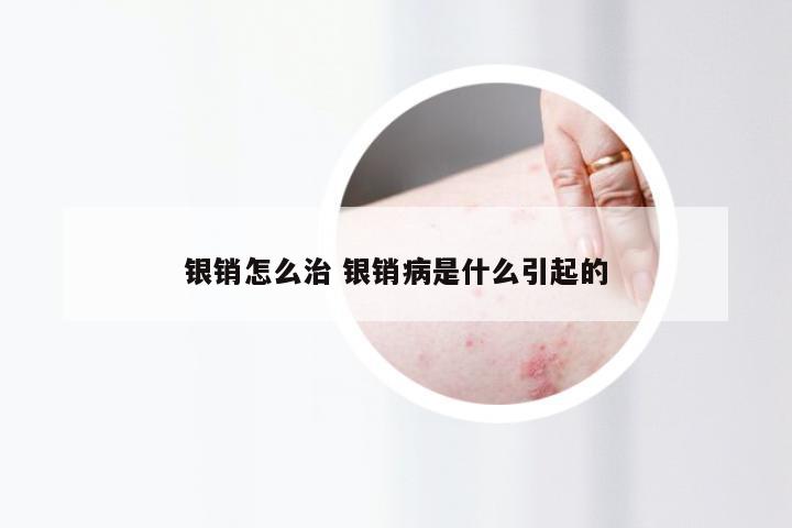 银销怎么治 银销病是什么引起的