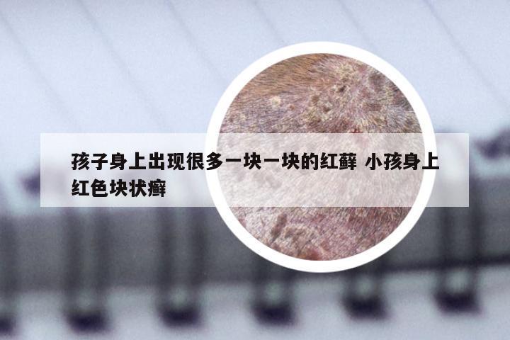 孩子身上出现很多一块一块的红藓 小孩身上红色块状癣