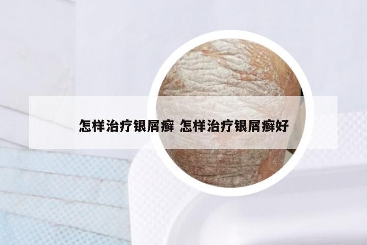 怎样治疗银屑癣 怎样治疗银屑癣好