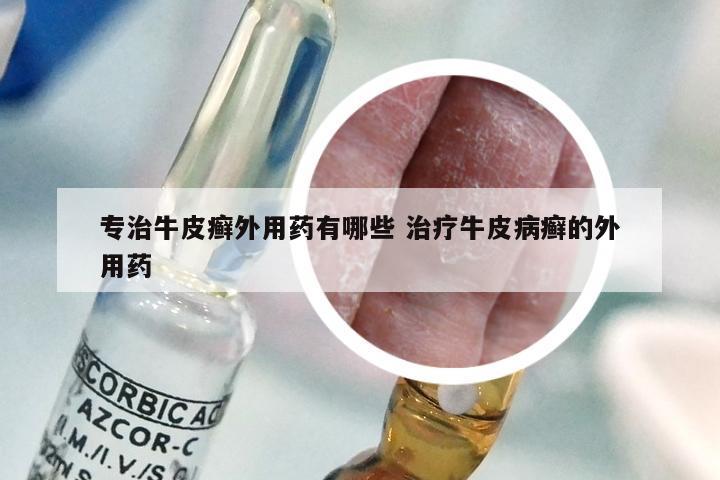 专治牛皮癣外用药有哪些 治疗牛皮病癣的外用药