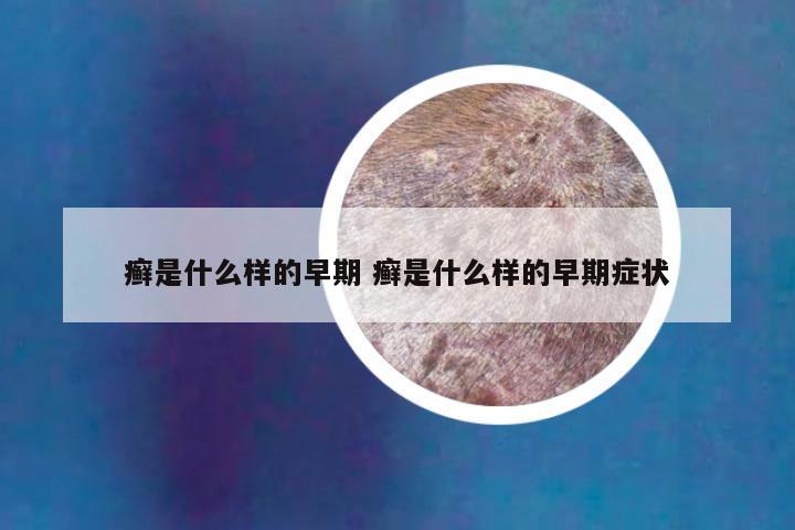 癣是什么样的早期 癣是什么样的早期症状