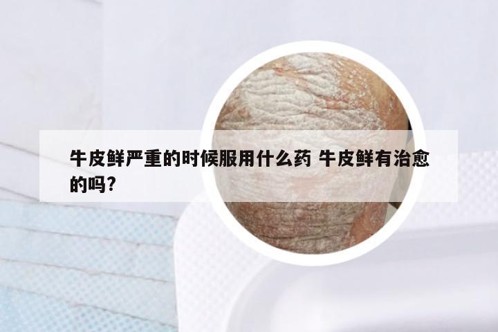 牛皮鲜严重的时候服用什么药 牛皮鲜有治愈的吗?