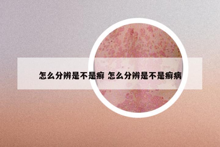 怎么分辨是不是癣 怎么分辨是不是癣病