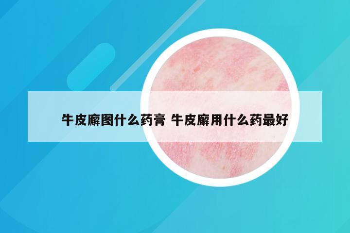 牛皮廨图什么药膏 牛皮廨用什么药最好