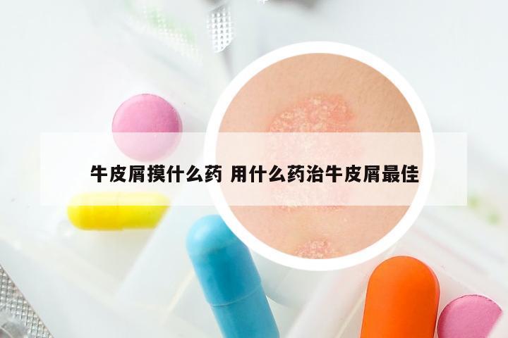 牛皮屑摸什么药 用什么药治牛皮屑最佳