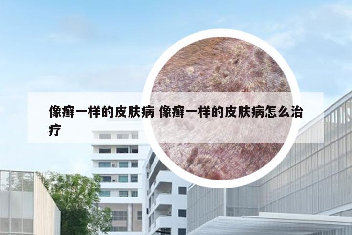 像癣一样的皮肤病 像癣一样的皮肤病怎么治疗