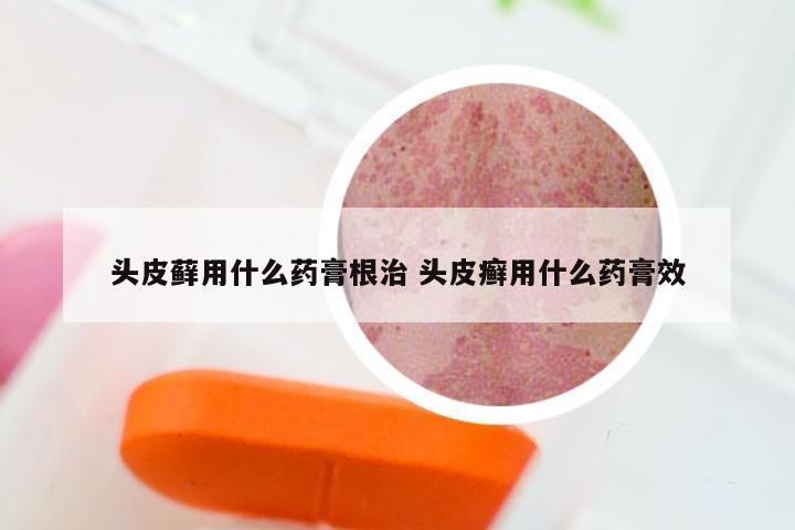 头皮藓用什么药膏根治 头皮癣用什么药膏效