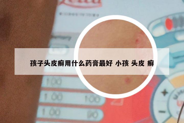 孩子头皮癣用什么药膏最好 小孩 头皮 癣
