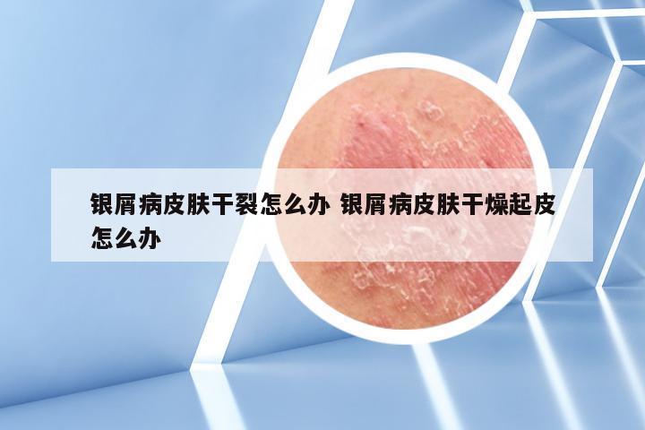 银屑病皮肤干裂怎么办 银屑病皮肤干燥起皮怎么办