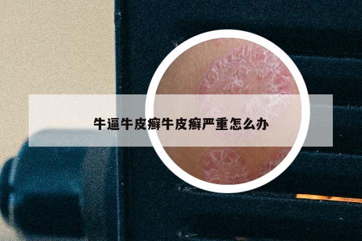 牛逼牛皮癣牛皮癣严重怎么办