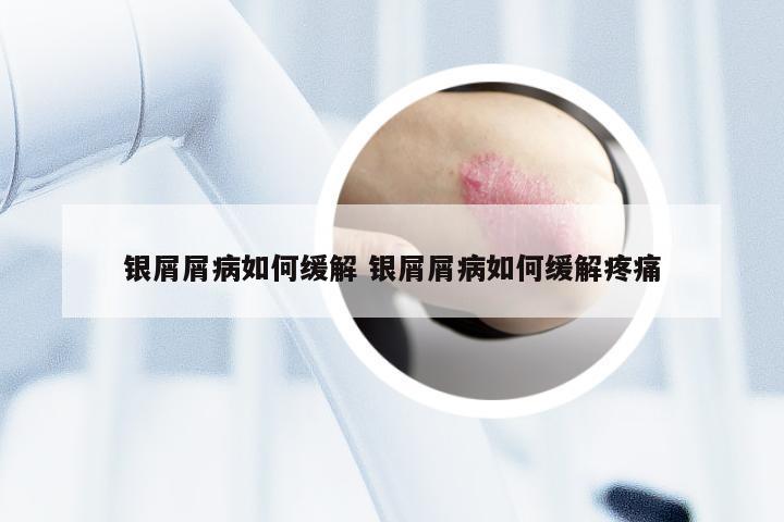 银屑屑病如何缓解 银屑屑病如何缓解疼痛