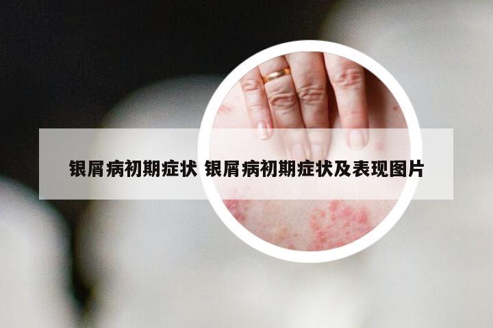 银屑病初期症状 银屑病初期症状及表现图片