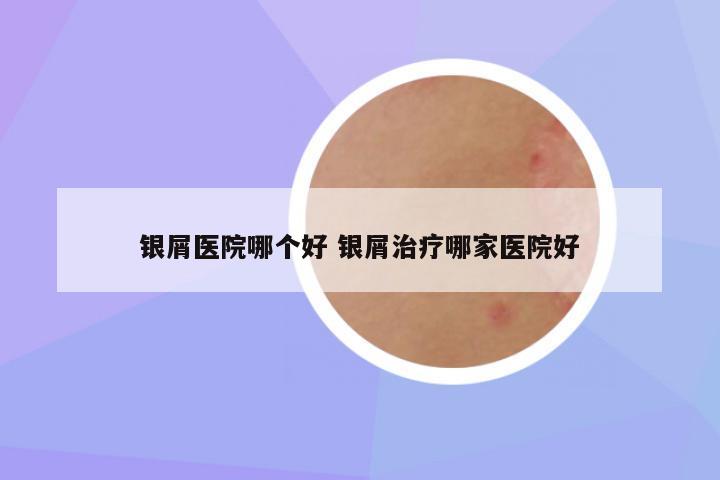 银屑医院哪个好 银屑治疗哪家医院好