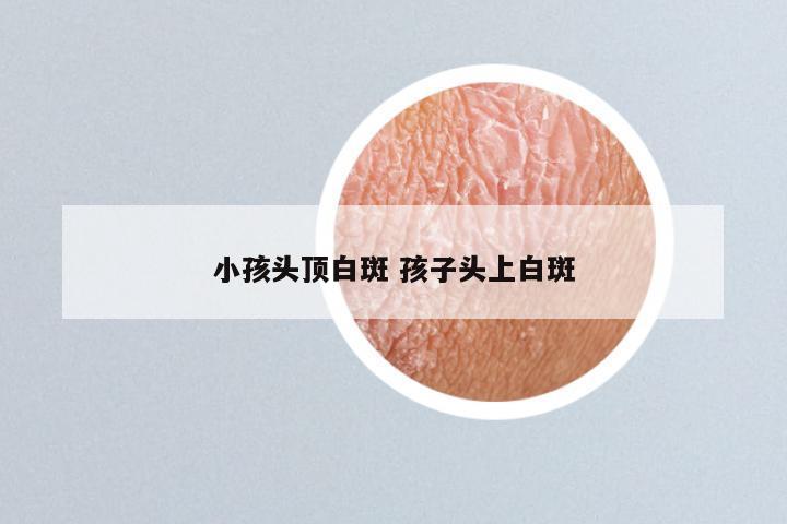 小孩头顶白斑 孩子头上白斑
