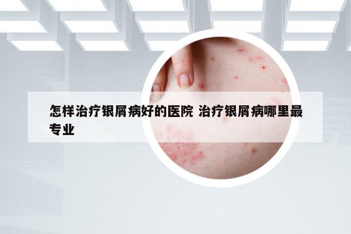 怎样治疗银屑病好的医院 治疗银屑病哪里最专业