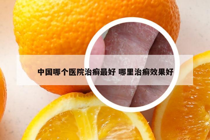 中国哪个医院治癣最好 哪里治癣效果好