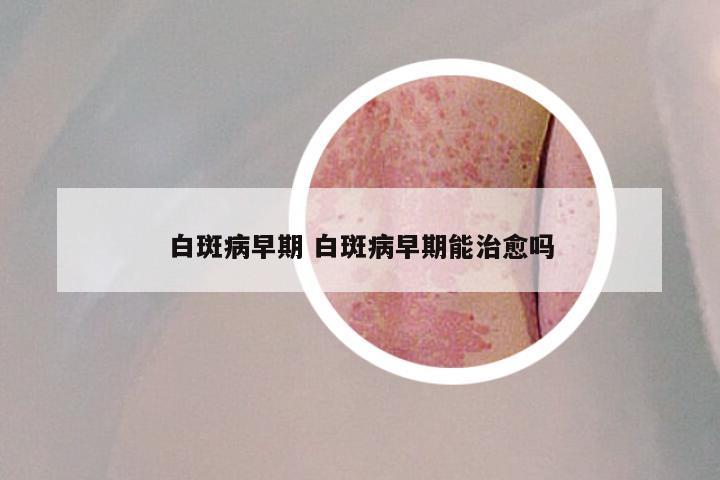 白斑病早期 白斑病早期能治愈吗