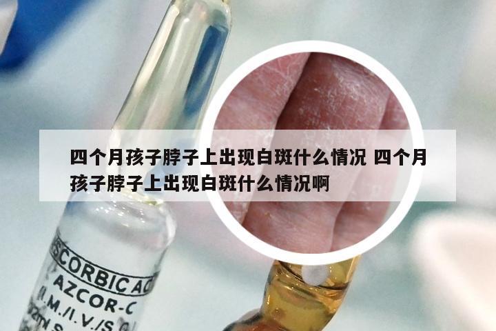 四个月孩子脖子上出现白斑什么情况 四个月孩子脖子上出现白斑什么情况啊