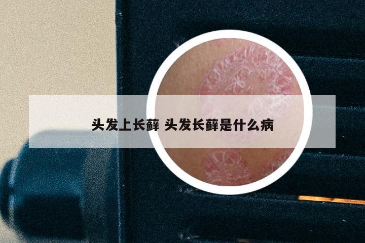 头发上长藓 头发长藓是什么病