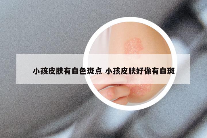 小孩皮肤有白色斑点 小孩皮肤好像有白斑