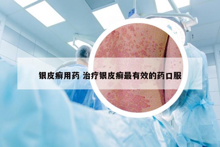 银皮癣用药 治疗银皮癣最有效的药口服