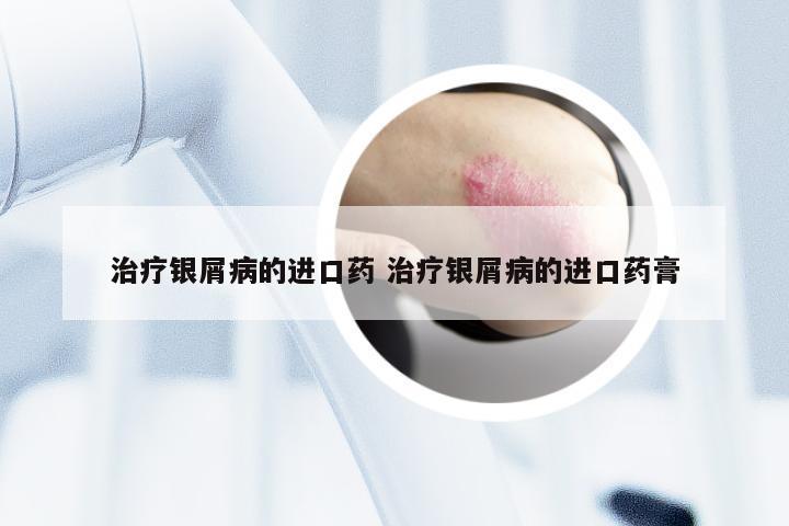 治疗银屑病的进口药 治疗银屑病的进口药膏