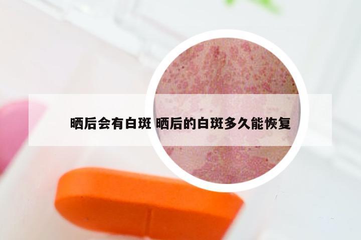 晒后会有白斑 晒后的白斑多久能恢复