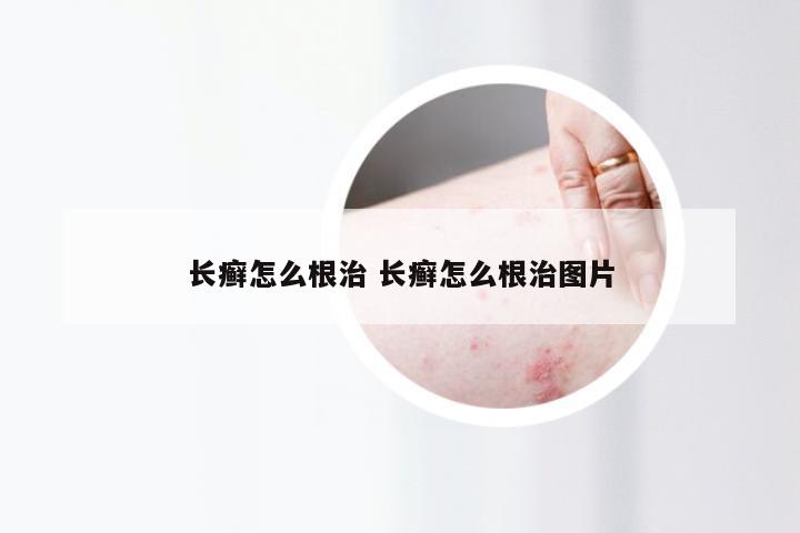 长癣怎么根治 长癣怎么根治图片