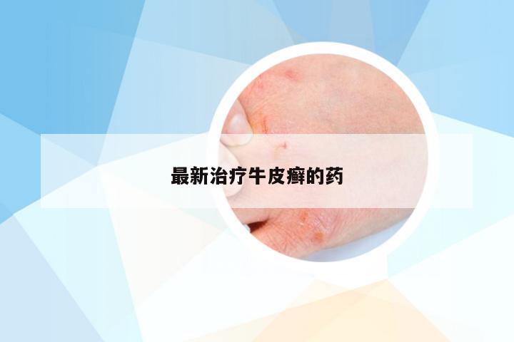 最新治疗牛皮癣的药