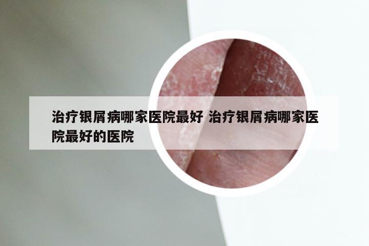 治疗银屑病哪家医院最好 治疗银屑病哪家医院最好的医院
