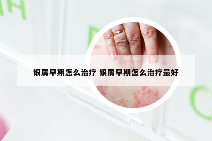 银屑早期怎么治疗 银屑早期怎么治疗最好