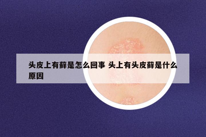 头皮上有藓是怎么回事 头上有头皮藓是什么原因