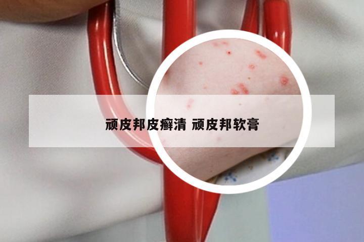 顽皮邦皮癣清 顽皮邦软膏