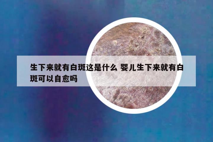 生下来就有白斑这是什么 婴儿生下来就有白斑可以自愈吗