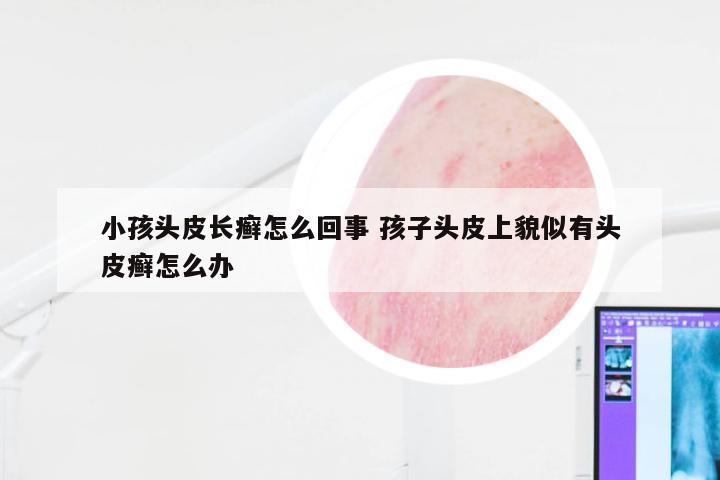 小孩头皮长癣怎么回事 孩子头皮上貌似有头皮癣怎么办