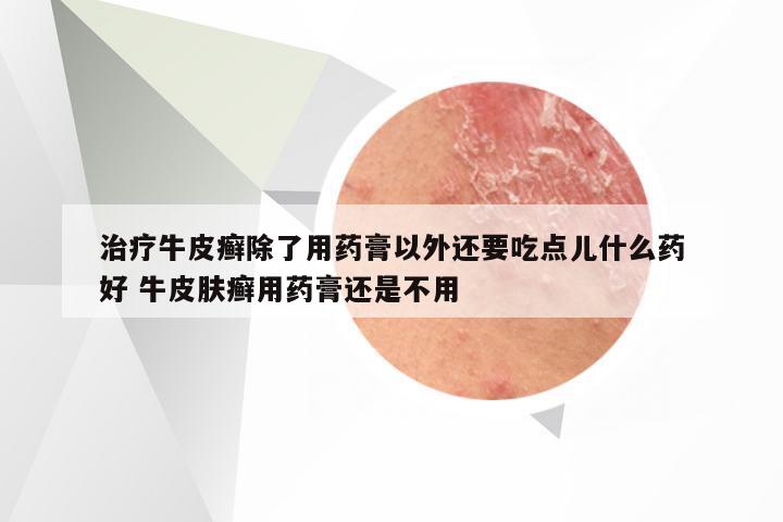 治疗牛皮癣除了用药膏以外还要吃点儿什么药好 牛皮肤癣用药膏还是不用