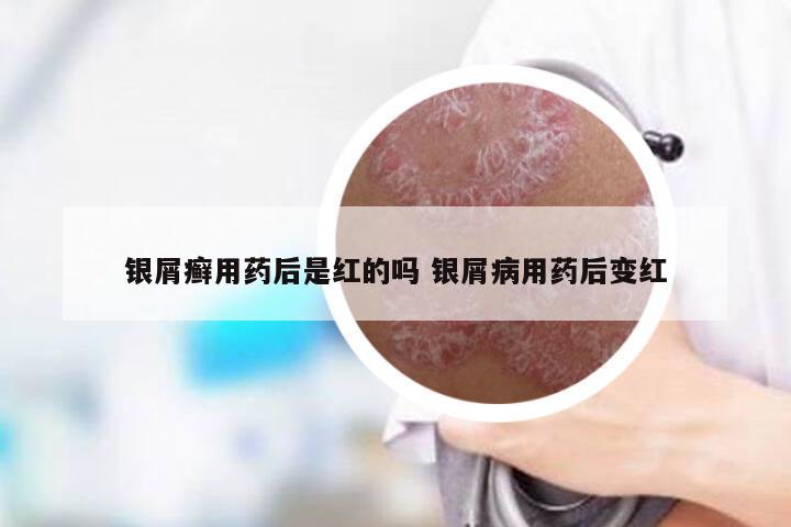 银屑癣用药后是红的吗 银屑病用药后变红