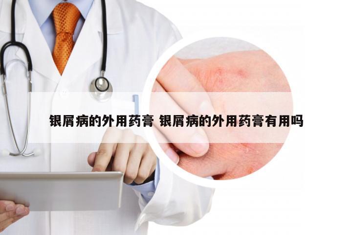 银屑病的外用药膏 银屑病的外用药膏有用吗