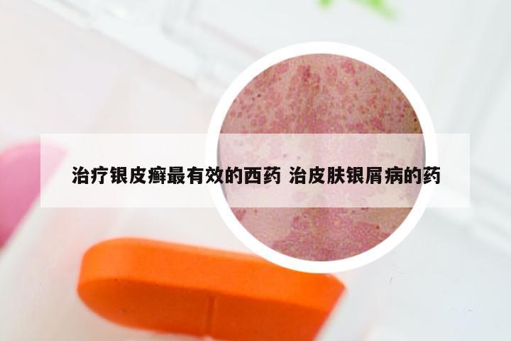 治疗银皮癣最有效的西药 治皮肤银屑病的药
