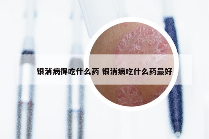 银消病得吃什么药 银消病吃什么药最好