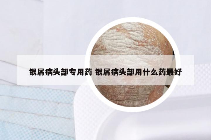银屑病头部专用药 银屑病头部用什么药最好