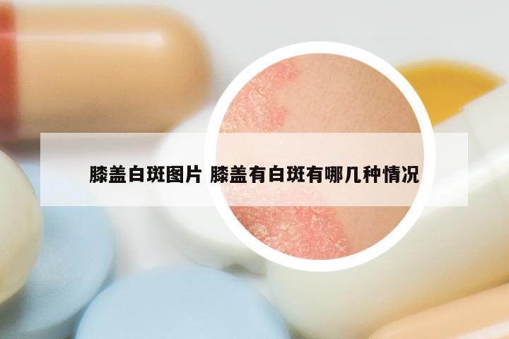 膝盖白斑图片 膝盖有白斑有哪几种情况