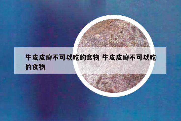 牛皮皮癣不可以吃的食物 牛皮皮癣不可以吃的食物
