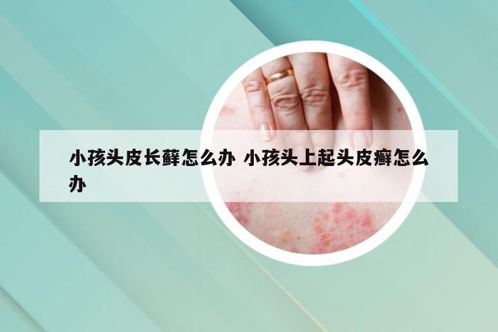 小孩头皮长藓怎么办 小孩头上起头皮癣怎么办