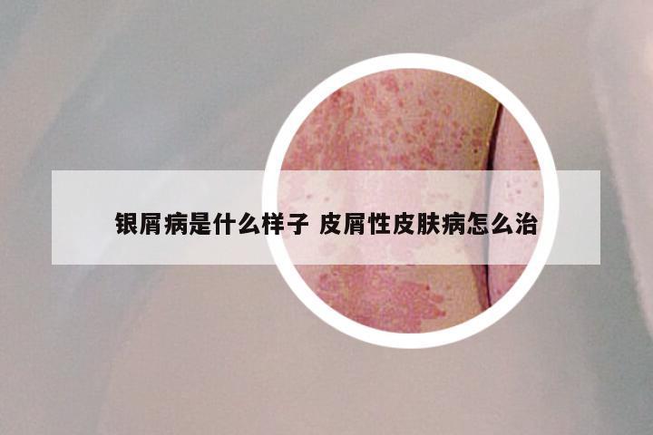 银屑病是什么样子 皮屑性皮肤病怎么治