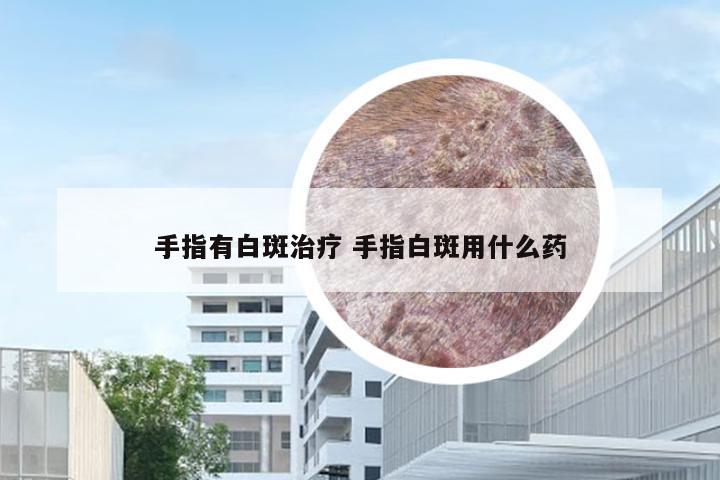 手指有白斑治疗 手指白斑用什么药