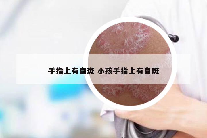 手指上有白斑 小孩手指上有白斑