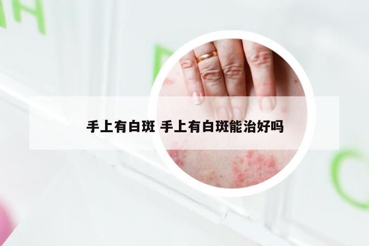 手上有白斑 手上有白斑能治好吗