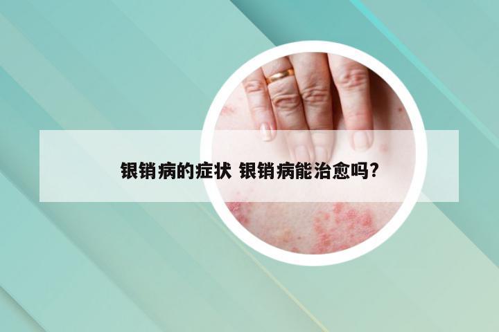 银销病的症状 银销病能治愈吗?